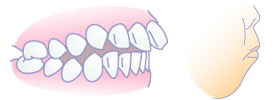 上顎前突（出っ歯）