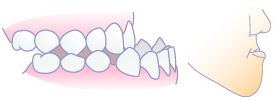 骨格性下顎前突（受け口）